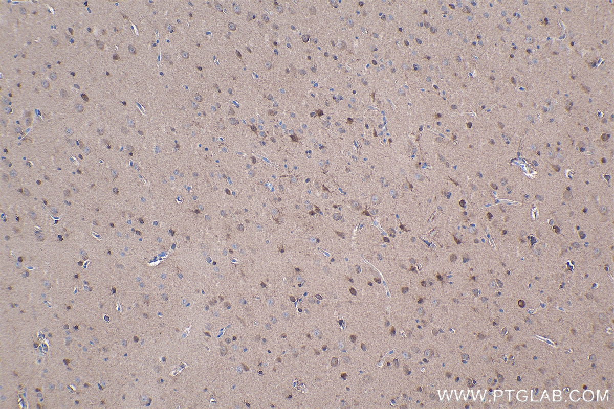 Immunohistochemical analysis of paraffin-embedded human gliomas tissue slide using KHC1000 (ACYP2 IHC Kit).