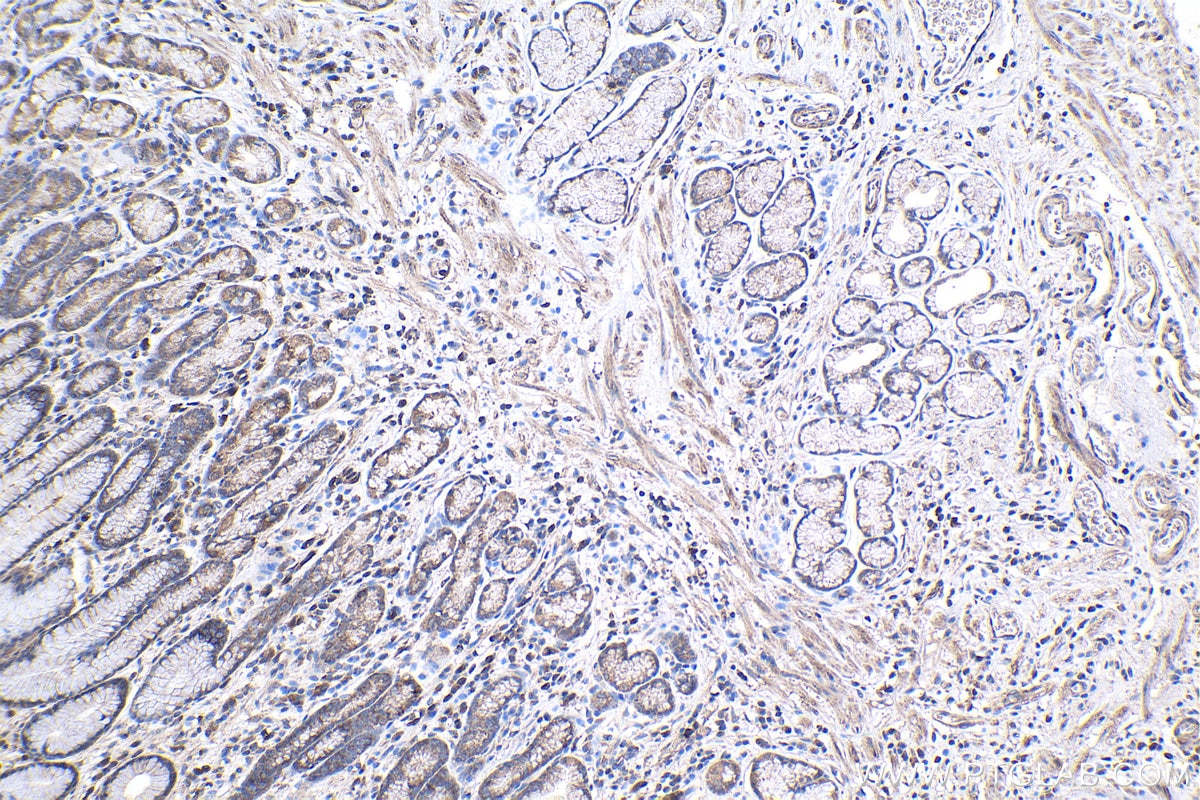 Immunohistochemical analysis of paraffin-embedded human stomach cancer tissue slide using KHC1000 (ACYP2 IHC Kit).