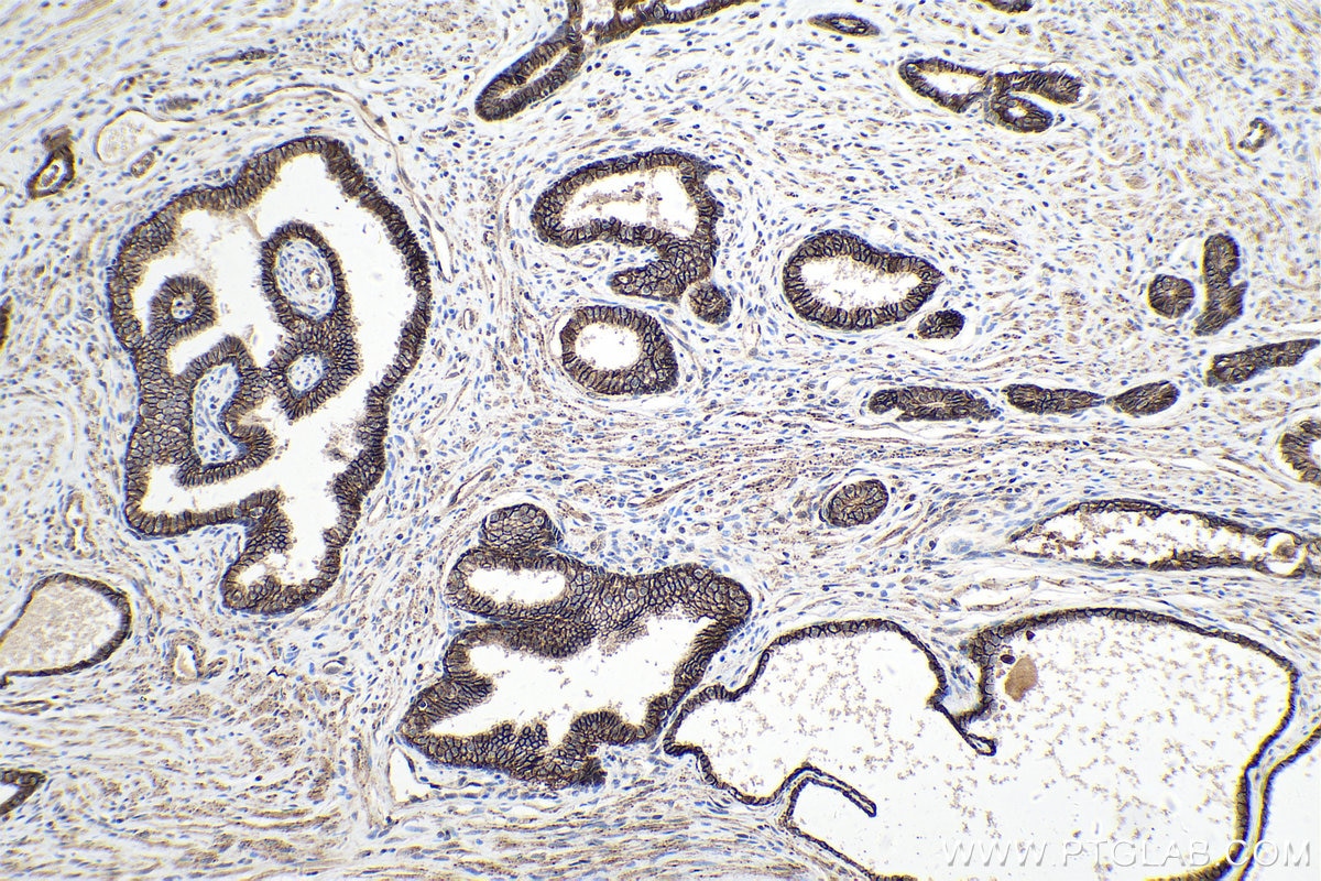 Immunohistochemical analysis of paraffin-embedded human prostate cancer tissue slide using KHC0219 (ADAM10 IHC Kit).