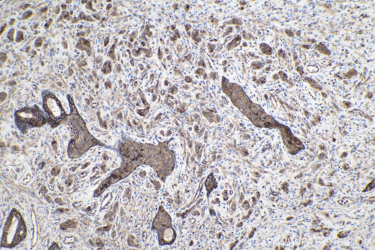 Immunohistochemical analysis of paraffin-embedded human prostate cancer tissue slide using KHC0219 (ADAM10 IHC Kit).