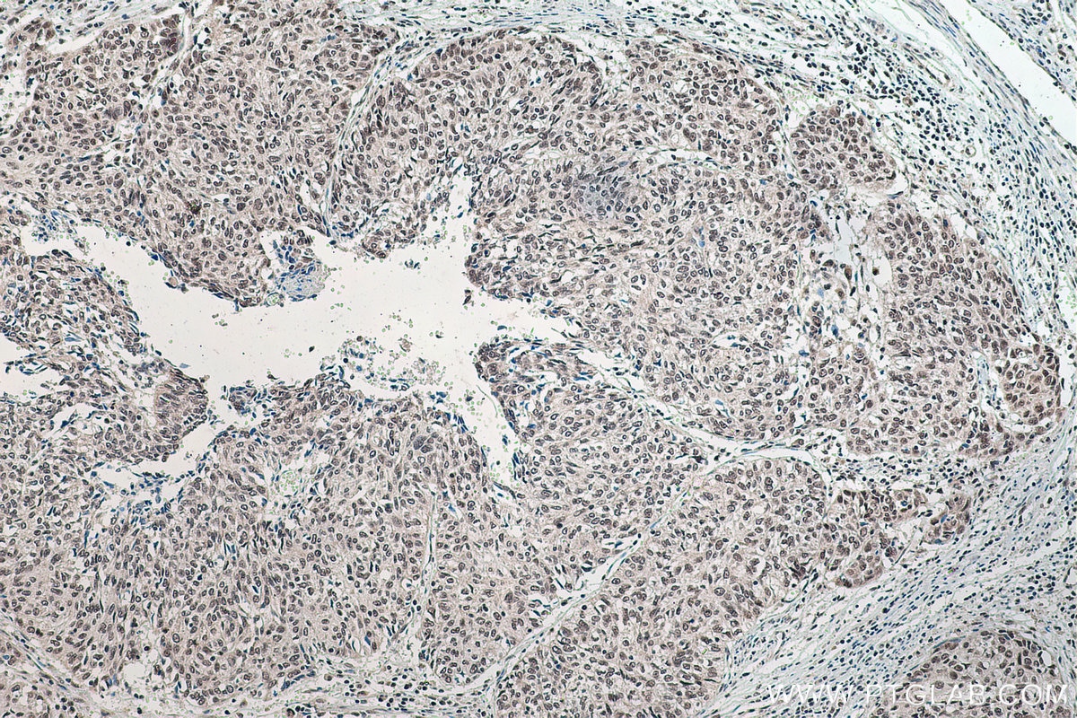 Immunohistochemical analysis of paraffin-embedded human cervical cancer tissue slide using KHC0183 (ADAR1 IHC Kit).