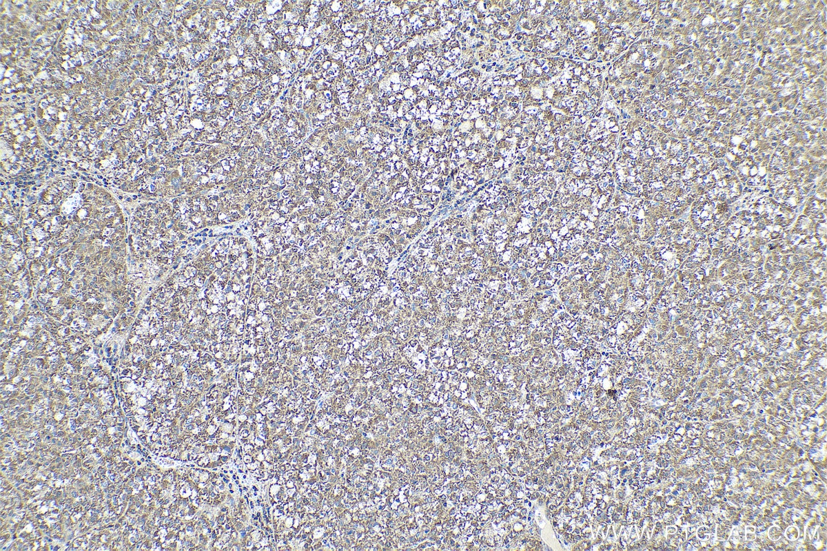 Immunohistochemical analysis of paraffin-embedded human liver cancer tissue slide using KHC0499 (ADH1B IHC Kit).