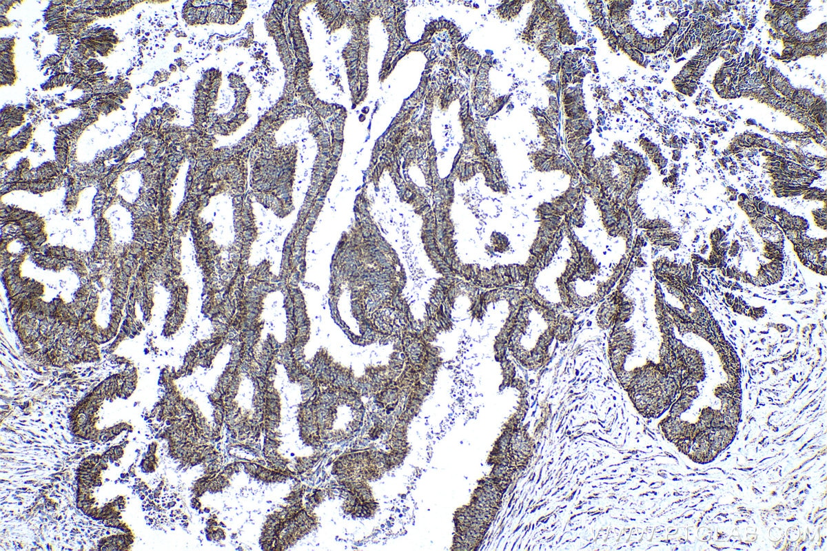 Immunohistochemical analysis of paraffin-embedded human ovary tumor tissue slide using KHC0499 (ADH1B IHC Kit).
