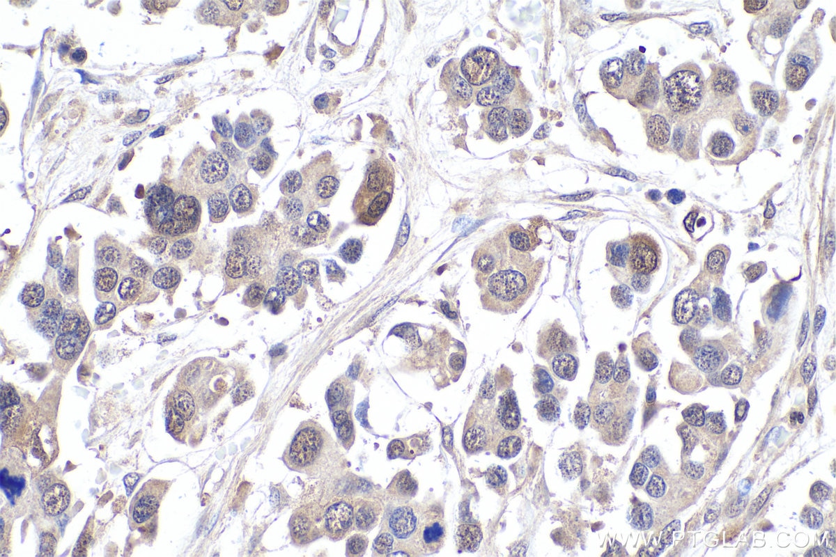 Immunohistochemical analysis of paraffin-embedded human colon cancer tissue slide using KHC0916 (ADI1 IHC Kit).