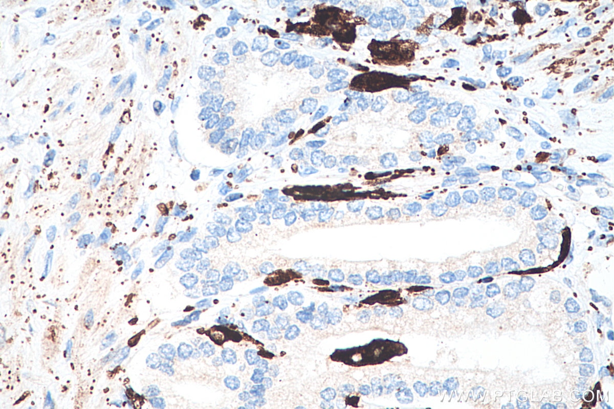Immunohistochemical analysis of paraffin-embedded human prostate cancer tissue slide using KHC0229 (ADRP IHC Kit).