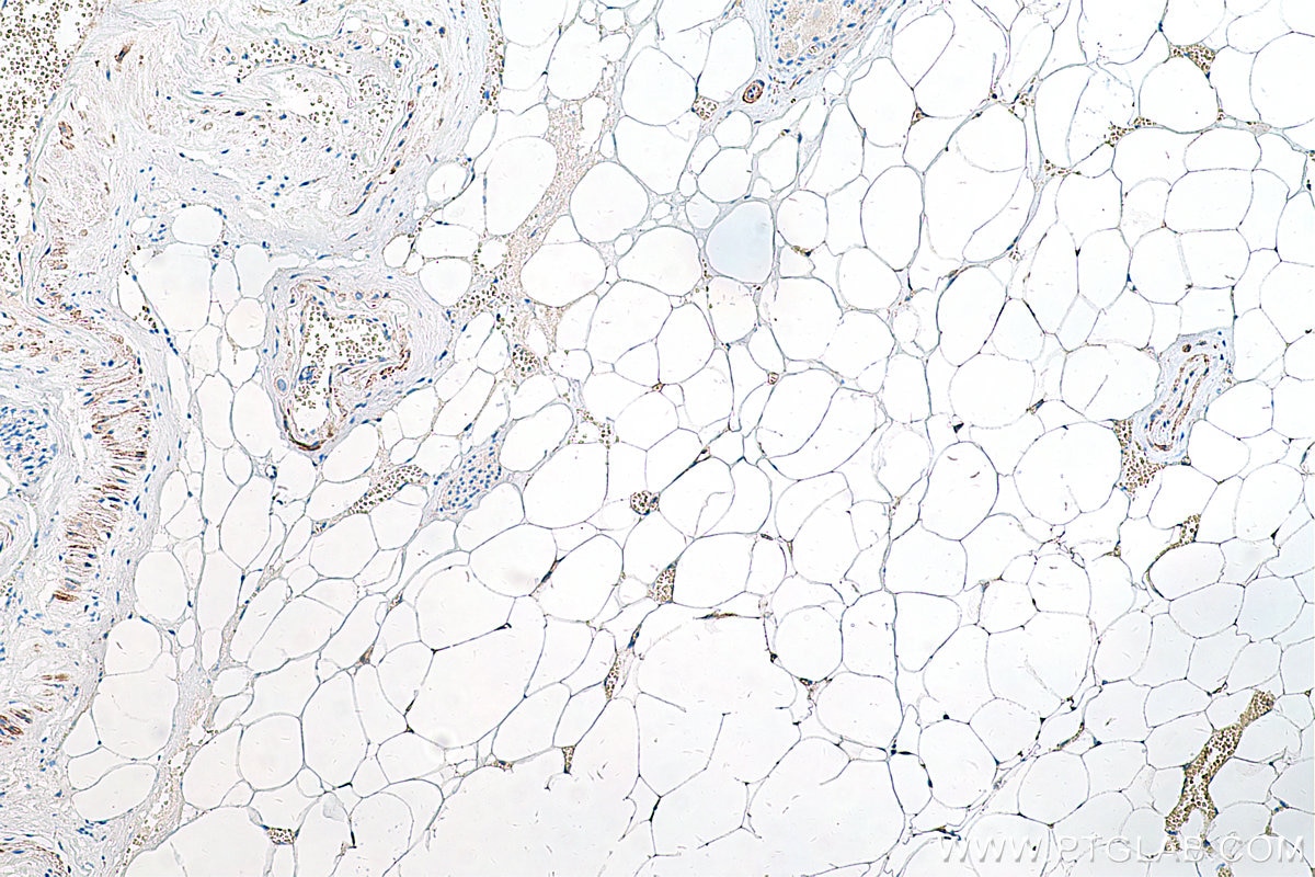 Immunohistochemical analysis of paraffin-embedded human prostate cancer tissue slide using KHC0229 (ADRP/Perilipin 2 IHC Kit).