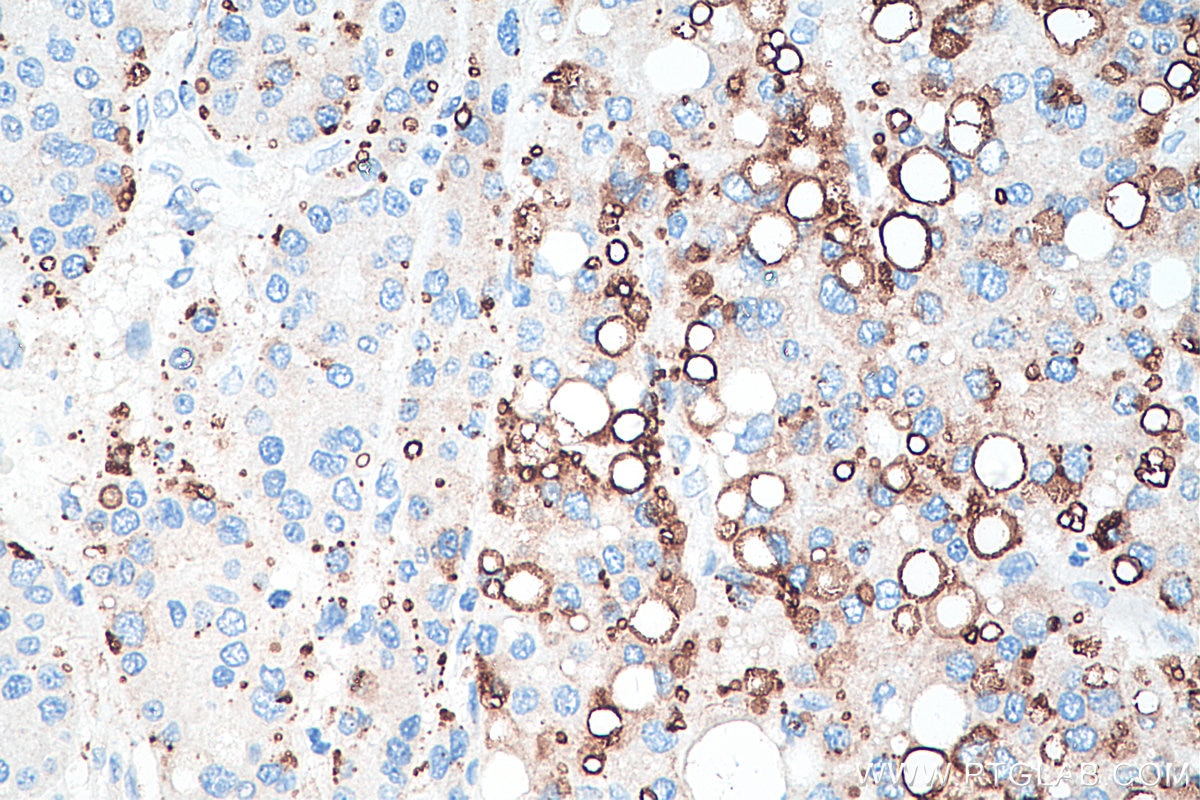 Immunohistochemical analysis of paraffin-embedded human liver cancer tissue slide using KHC0229 (ADRP IHC Kit).
