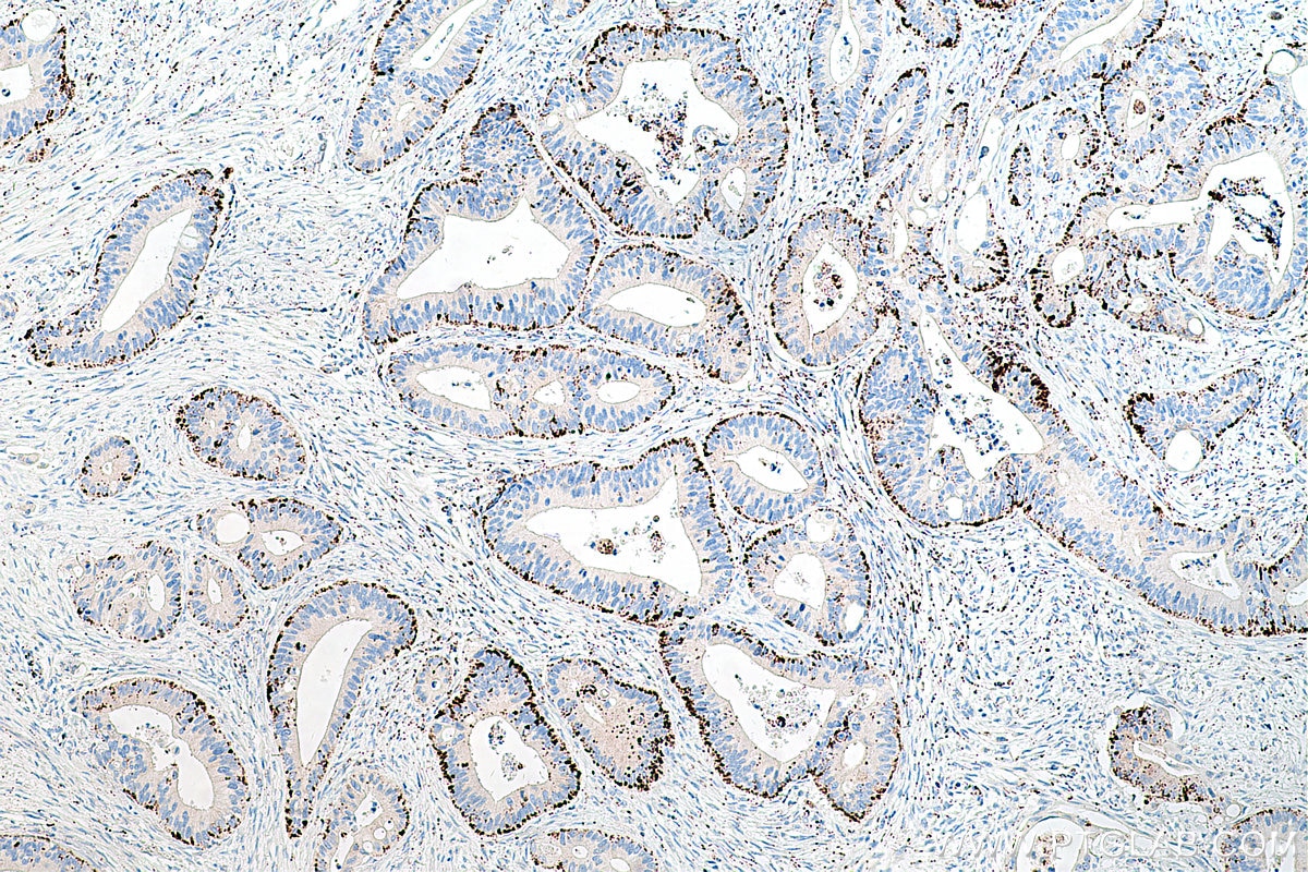 Immunohistochemical analysis of paraffin-embedded human colon cancer tissue slide using KHC0229 (ADRP IHC Kit).