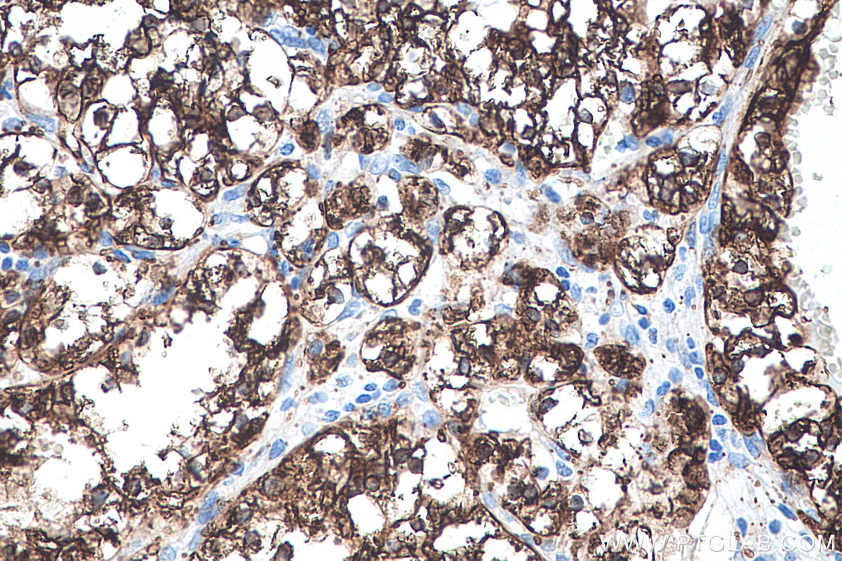 Immunohistochemical analysis of paraffin-embedded human renal cell carcinoma tissue slide using KHC0229 (ADRP IHC Kit).
