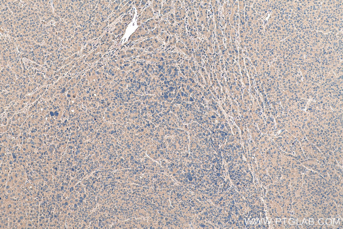 Immunohistochemical analysis of paraffin-embedded human liver cancer tissue slide using KHC0380 (AFP IHC Kit).