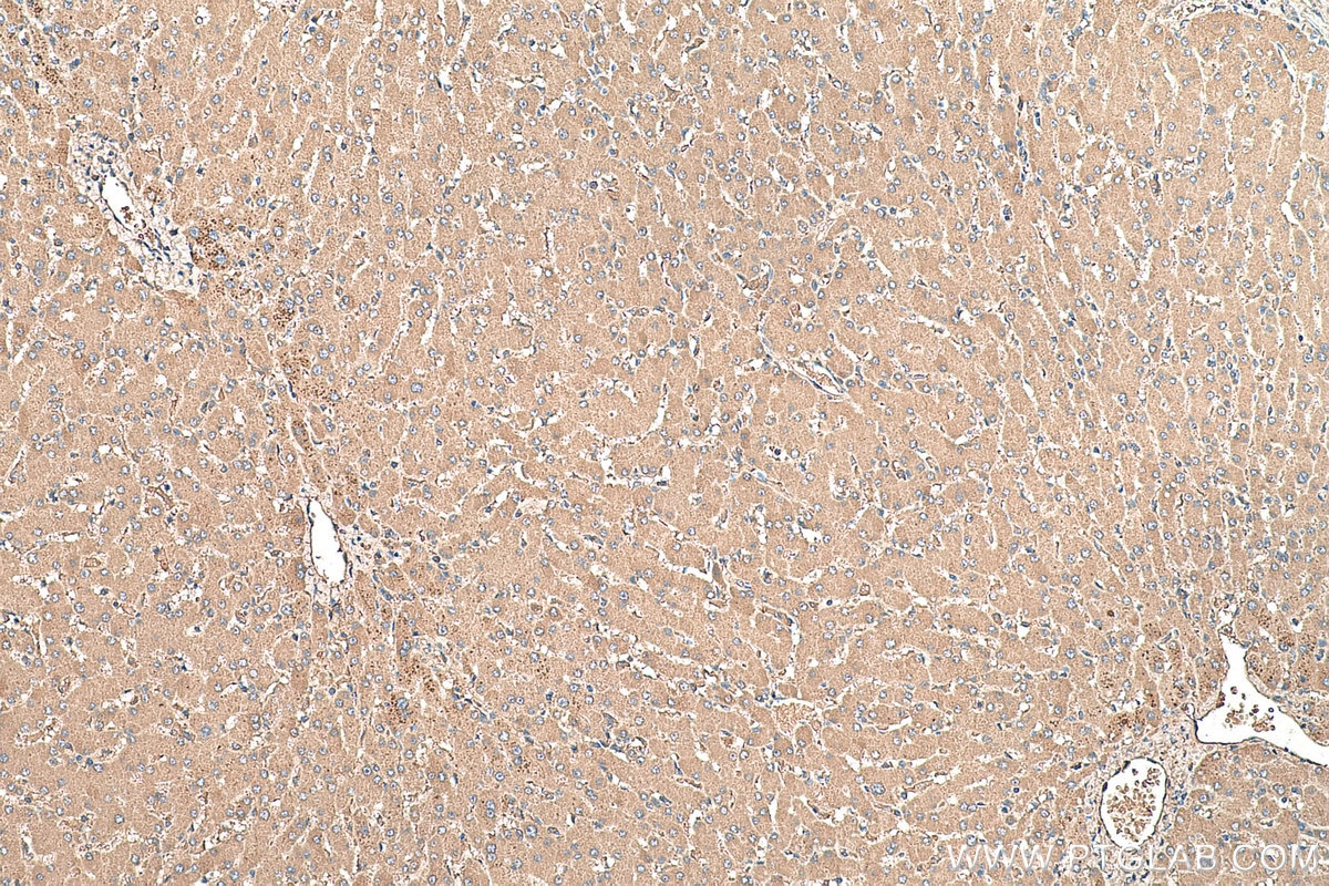 Immunohistochemical analysis of paraffin-embedded human liver tissue slide using KHC0380 (AFP IHC Kit).