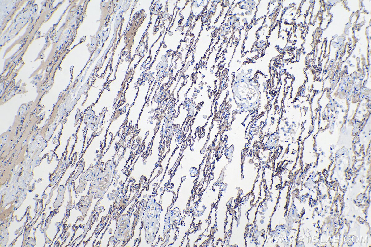Immunohistochemical analysis of paraffin-embedded human lung cancer(ANCT) tissue slide using KHC1095 (AGER IHC Kit).