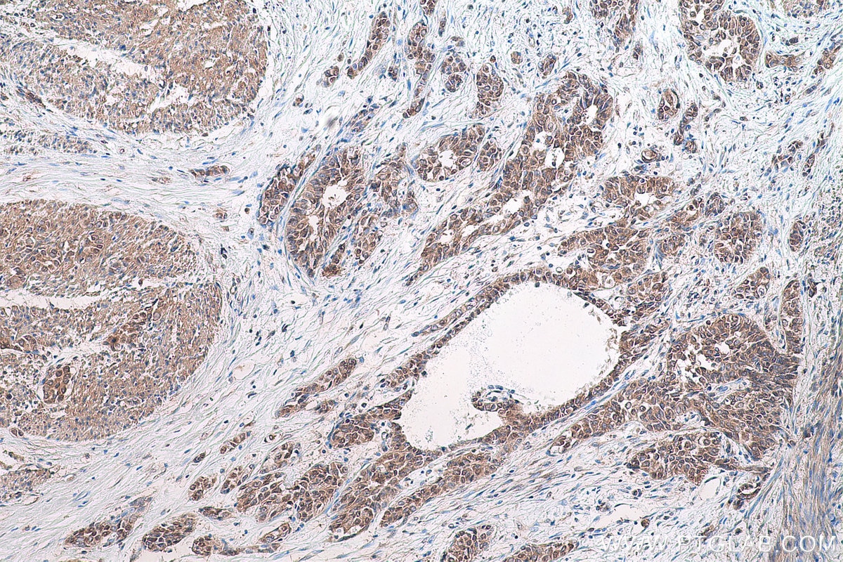 Immunohistochemical analysis of paraffin-embedded human urothelial carcinoma tissue slide using KHC0797 (AGO2/EIF2C2 IHC Kit).