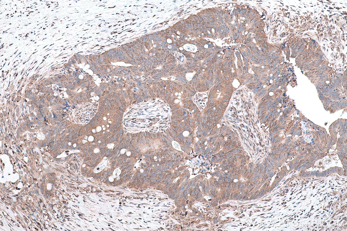 Immunohistochemical analysis of paraffin-embedded human colon cancer tissue slide using KHC0797 (AGO2/EIF2C2 IHC Kit).