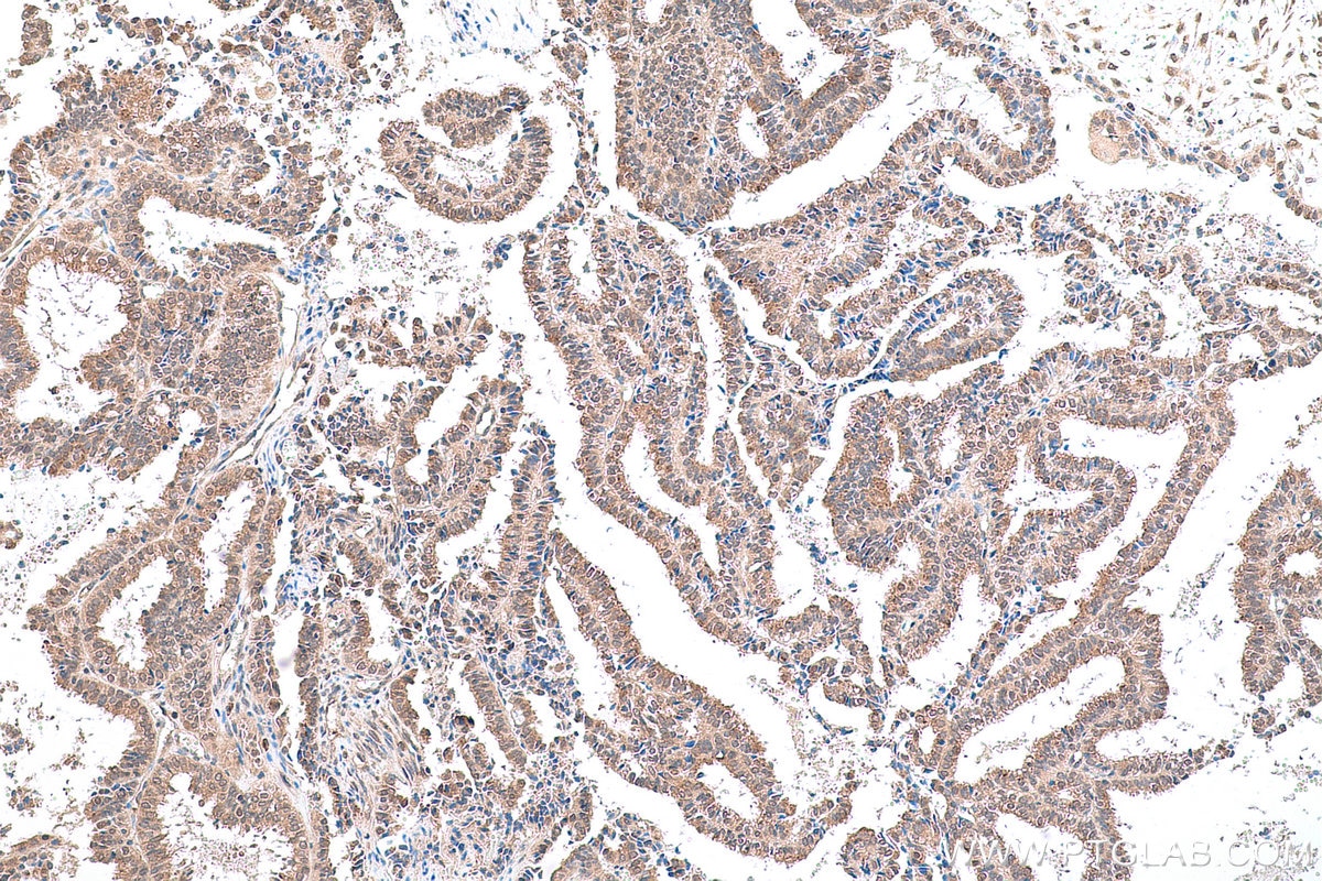 Immunohistochemical analysis of paraffin-embedded human ovary tumor tissue slide using KHC0797 (AGO2/EIF2C2 IHC Kit).