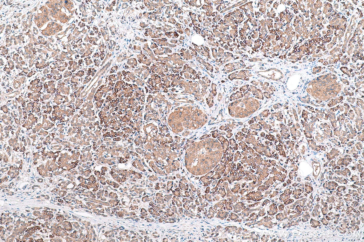 Immunohistochemical analysis of paraffin-embedded human pancreas cancer tissue slide using KHC0797 (AGO2/EIF2C2 IHC Kit).