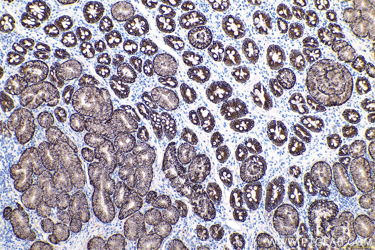Immunohistochemical analysis of paraffin-embedded human stomach cancer tissue slide using KHC0653 (AGR2 IHC Kit).