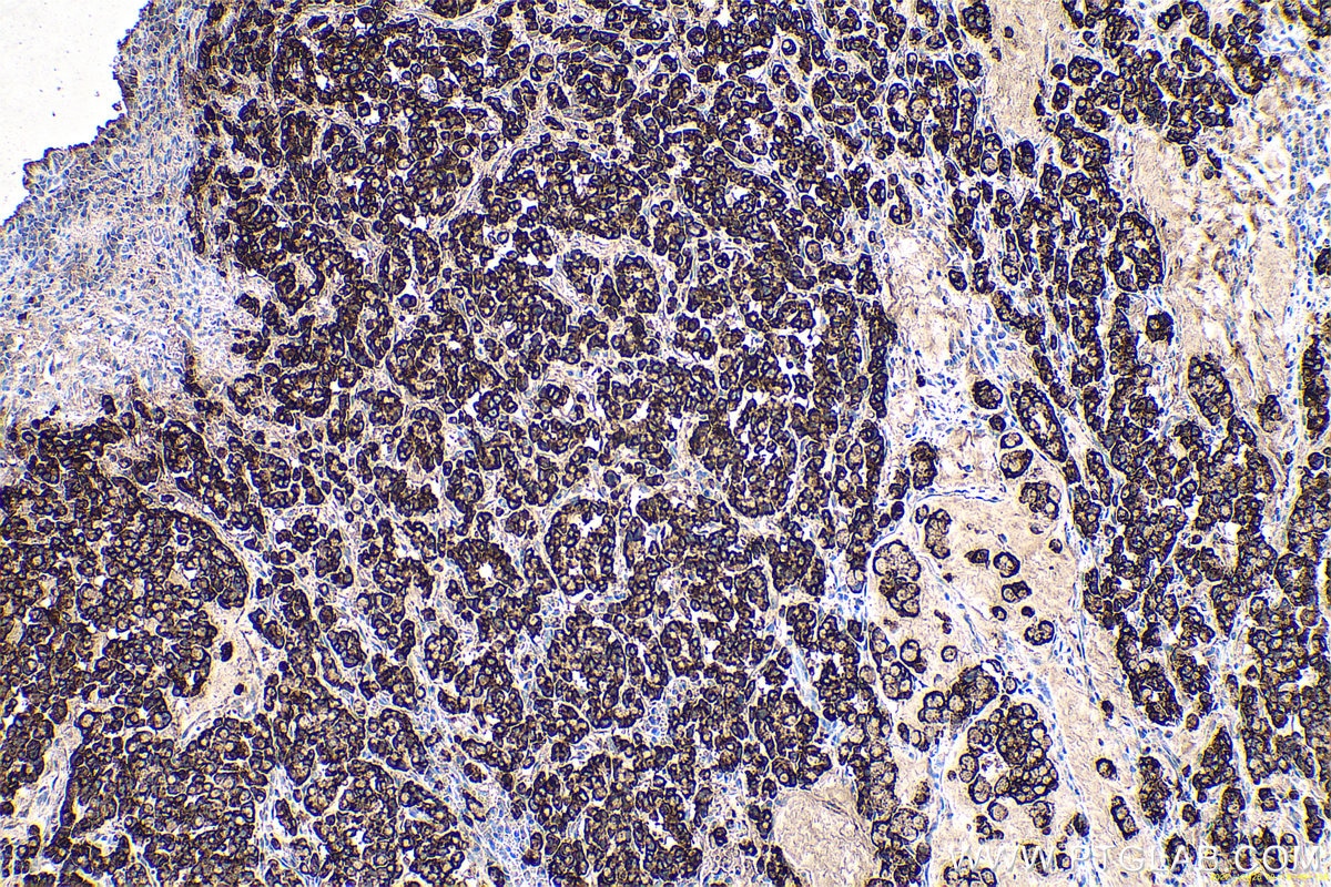 Immunohistochemical analysis of paraffin-embedded human colon cancer tissue slide using KHC0653 (AGR2 IHC Kit).