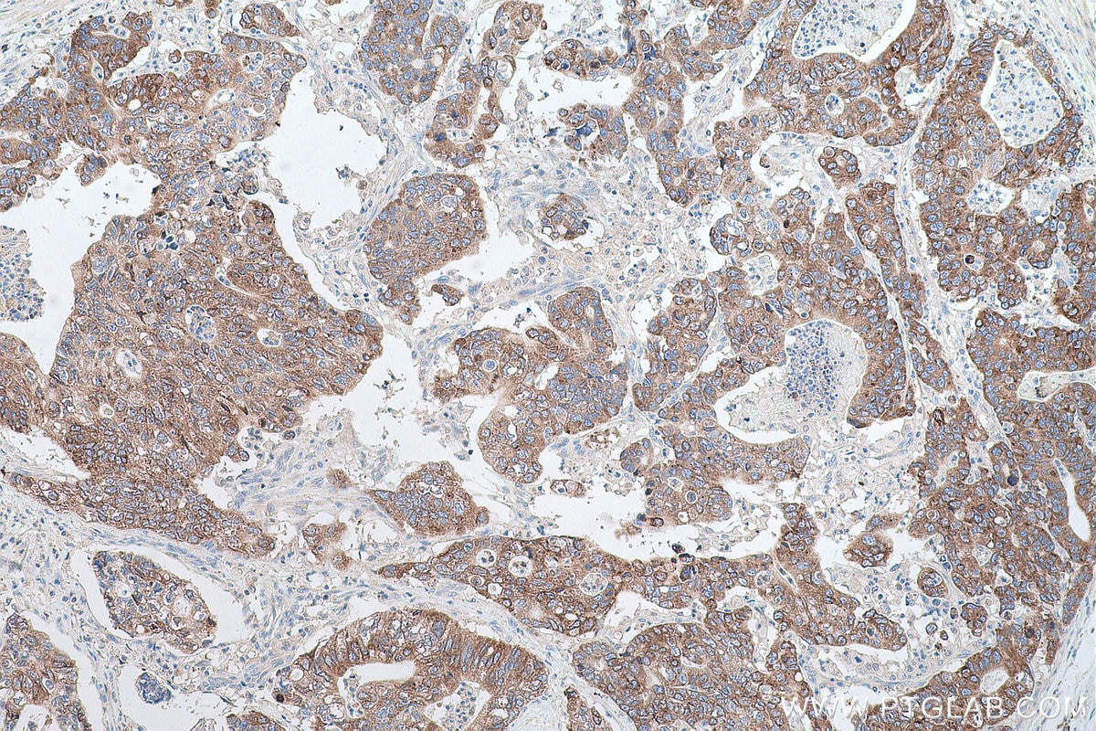 Immunohistochemical analysis of paraffin-embedded human stomach cancer tissue slide using KHC0693 (AGR3 IHC Kit).