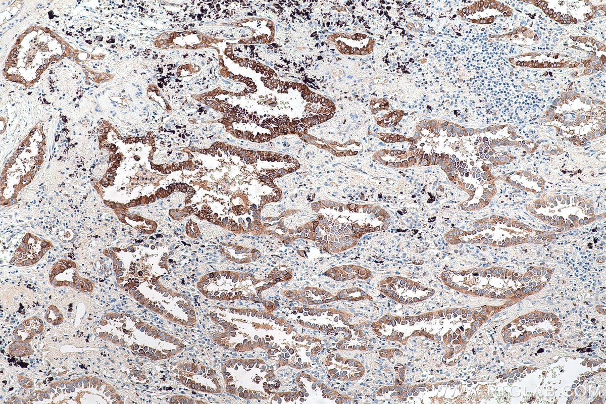 Immunohistochemical analysis of paraffin-embedded human lung cancer tissue slide using KHC0693 (AGR3 IHC Kit).