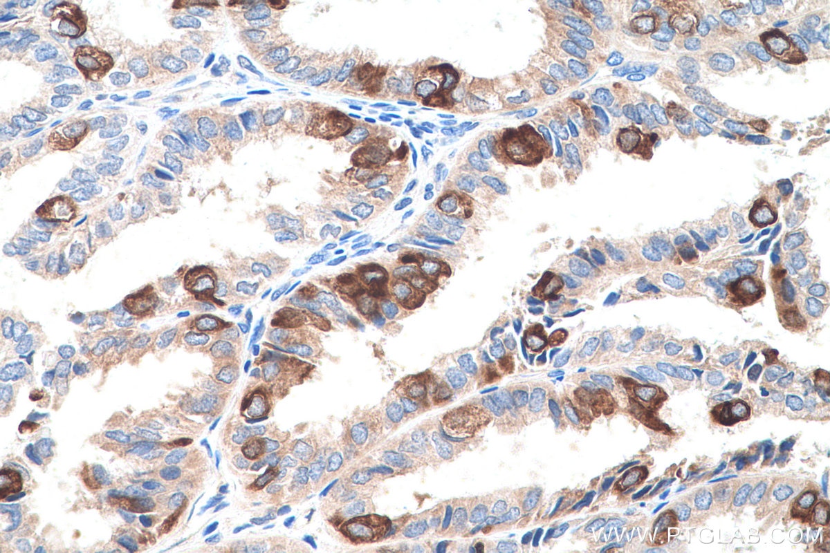 Immunohistochemical analysis of paraffin-embedded human ovary tumor tissue slide using KHC0693 (AGR3 IHC Kit).