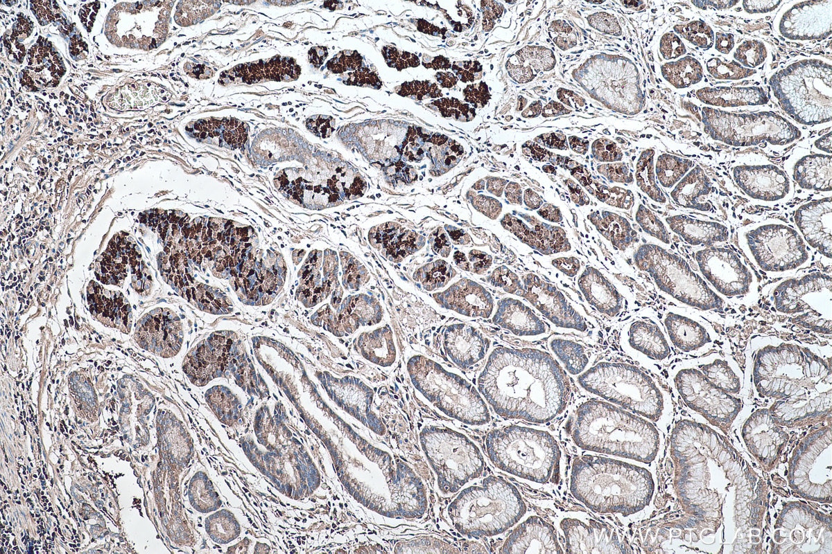 Immunohistochemical analysis of paraffin-embedded human stomach cancer(NAT) tissue slide using KHC0490 (AGT IHC Kit).