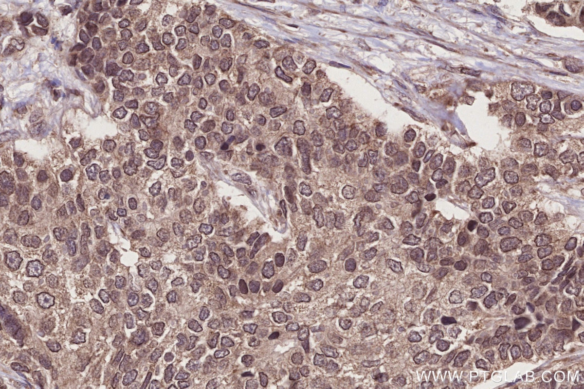 Immunohistochemical analysis of paraffin-embedded human stomach cancer tissue slide using KHC2744 (AHCTF1 IHC Kit).
