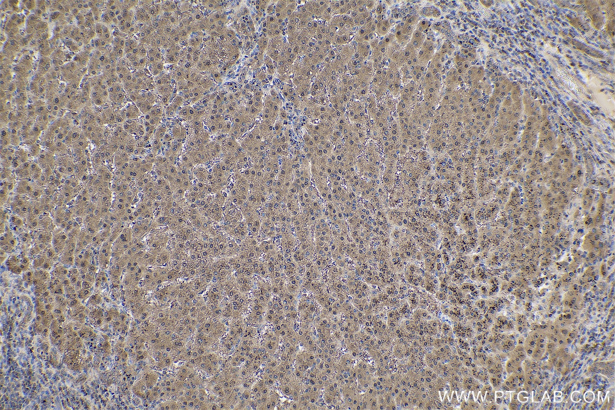 Immunohistochemical analysis of paraffin-embedded human liver cancer tissue slide using KHC0776 (AHCY IHC Kit).