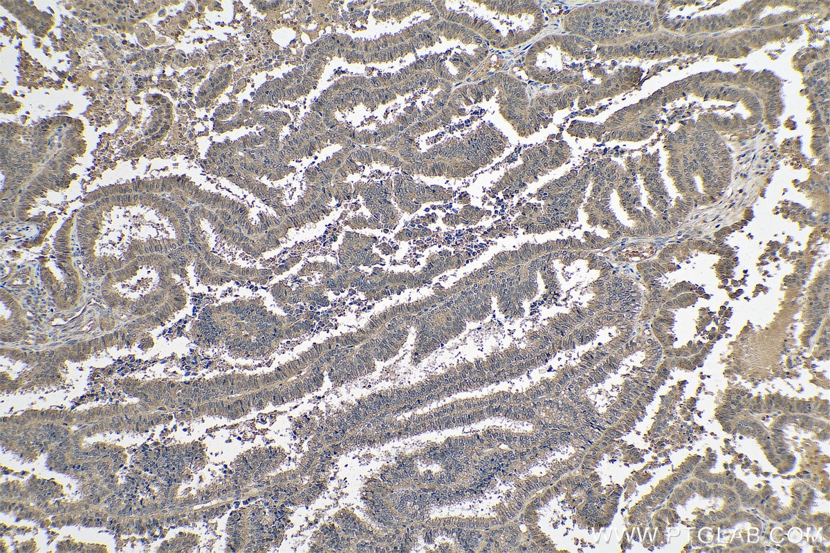 Immunohistochemical analysis of paraffin-embedded human ovary tumor tissue slide using KHC0776 (AHCY IHC Kit).