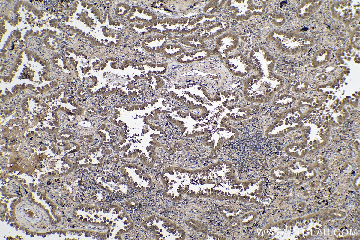 Immunohistochemical analysis of paraffin-embedded human lung cancer tissue slide using KHC0776 (AHCY IHC Kit).