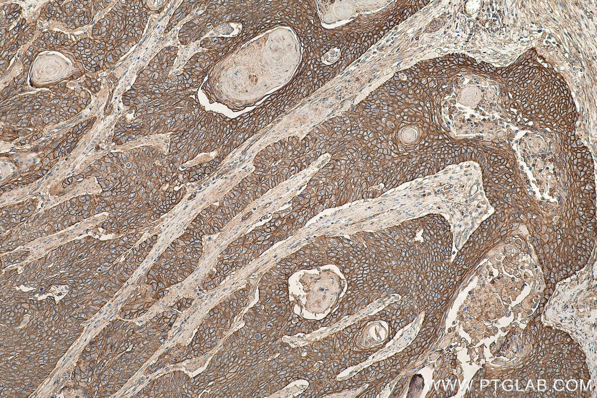 Immunohistochemical analysis of paraffin-embedded human oesophagus cancer tissue slide using KHC0658 (AHNAK IHC Kit).