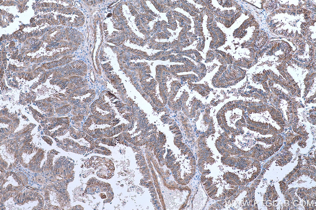 Immunohistochemical analysis of paraffin-embedded human ovary tumor tissue slide using KHC0658 (AHNAK IHC Kit).