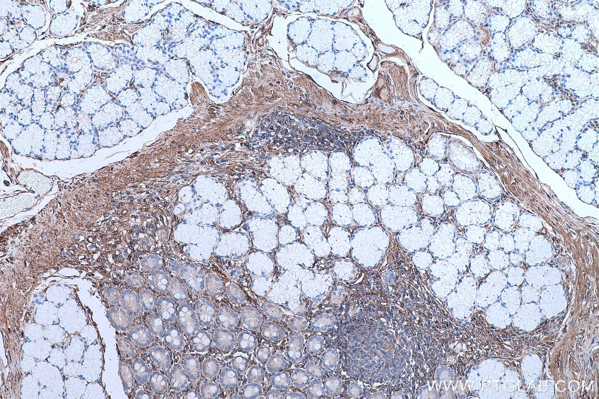 Immunohistochemical analysis of paraffin-embedded human stomach cancer tissue slide using KHC0658 (AHNAK IHC Kit).