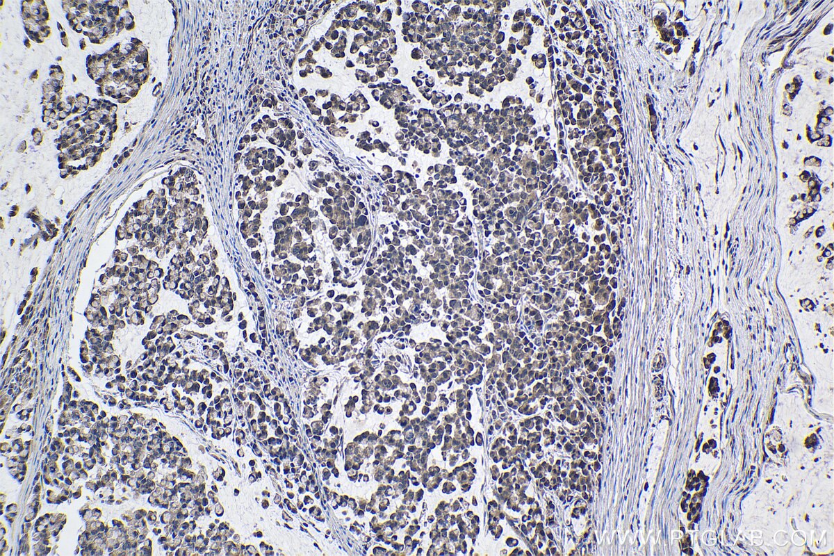 Immunohistochemical analysis of paraffin-embedded human colon cancer tissue slide using KHC1055 (AHR IHC Kit).