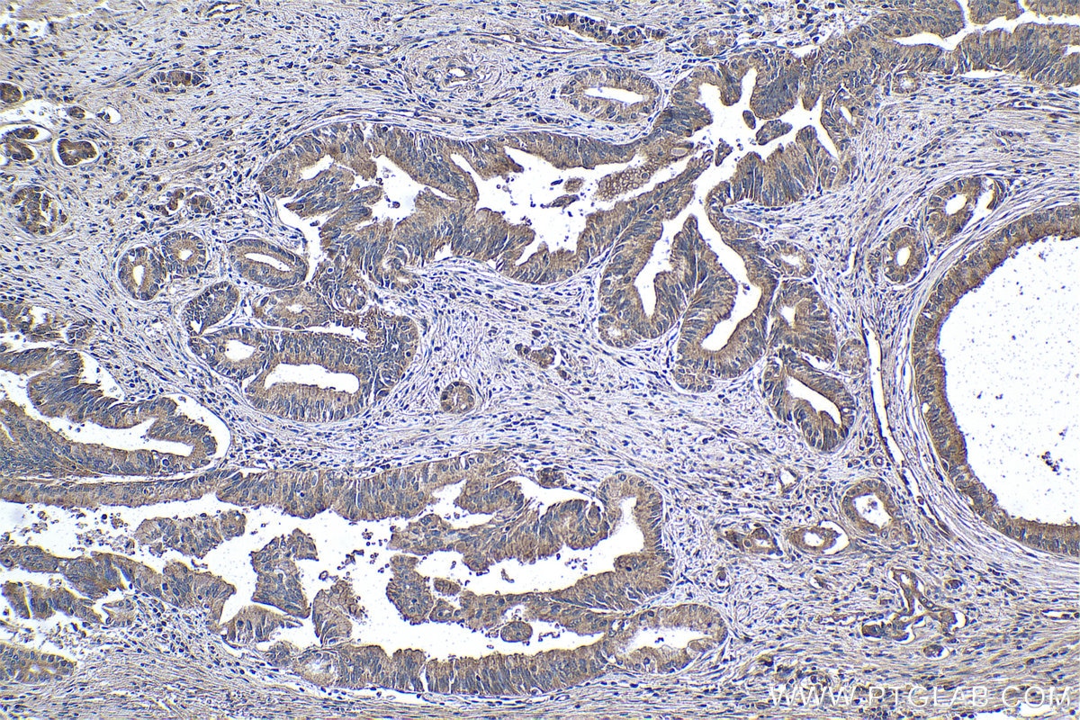 Immunohistochemical analysis of paraffin-embedded human pancreas cancer tissue slide using KHC1055 (AHR IHC Kit).
