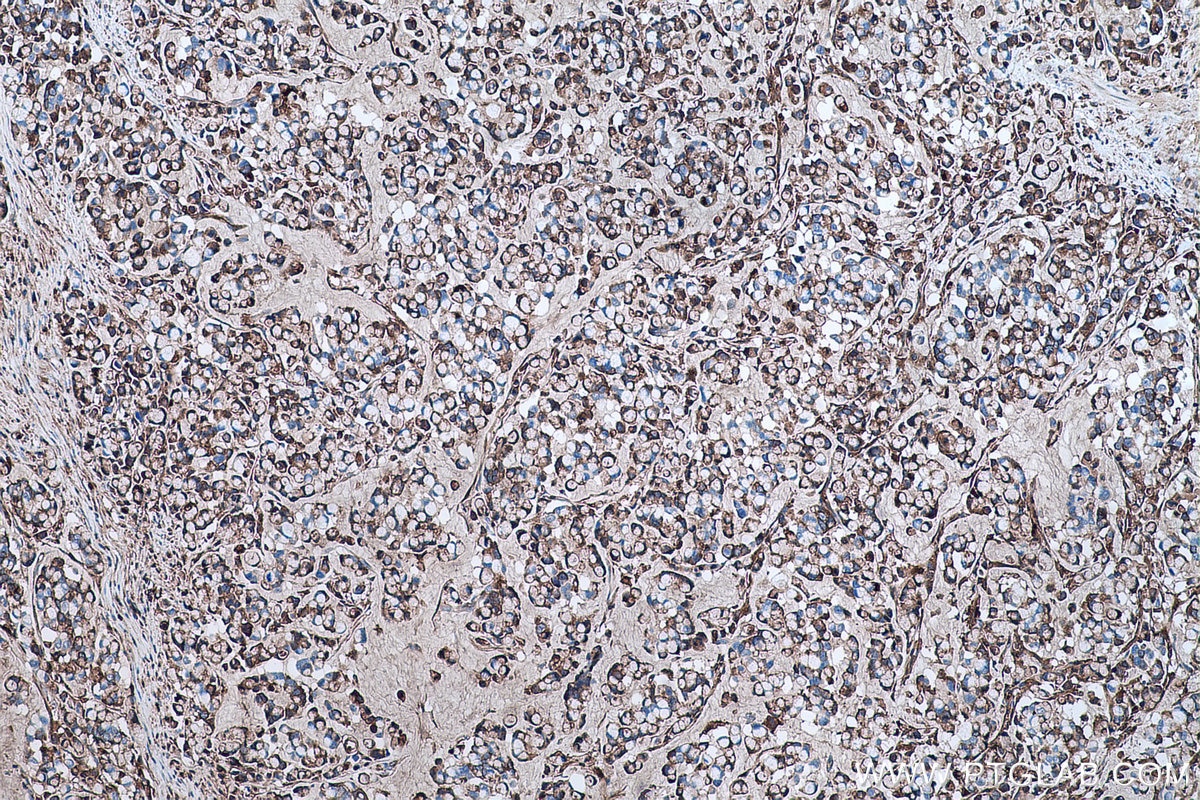 Immunohistochemical analysis of paraffin-embedded human colon cancer tissue slide using KHC0483 (AHSG/Fetuin A IHC Kit).