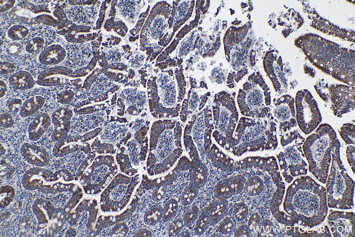 Immunohistochemical analysis of paraffin-embedded human stomach cancer tissue slide using KHC1349 (AIFM1 IHC Kit).