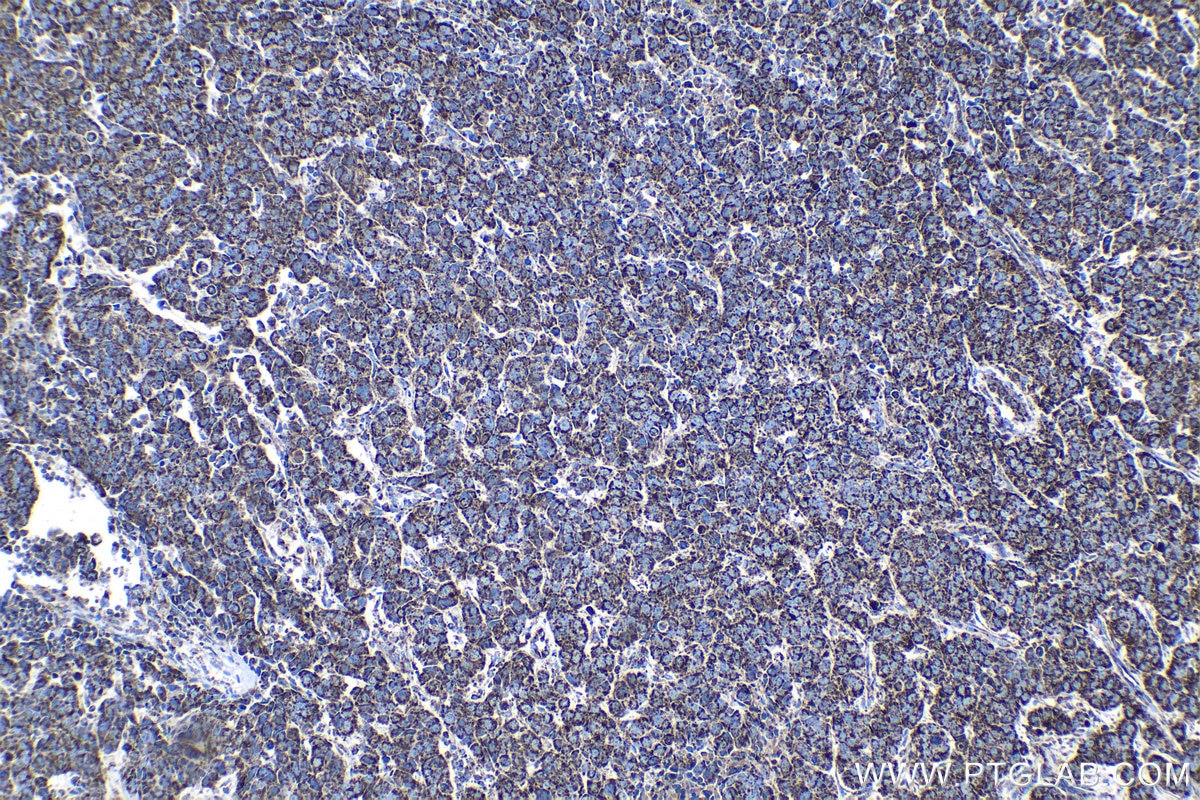 Immunohistochemical analysis of paraffin-embedded human breast cancer tissue slide using KHC1349 (AIFM1 IHC Kit).