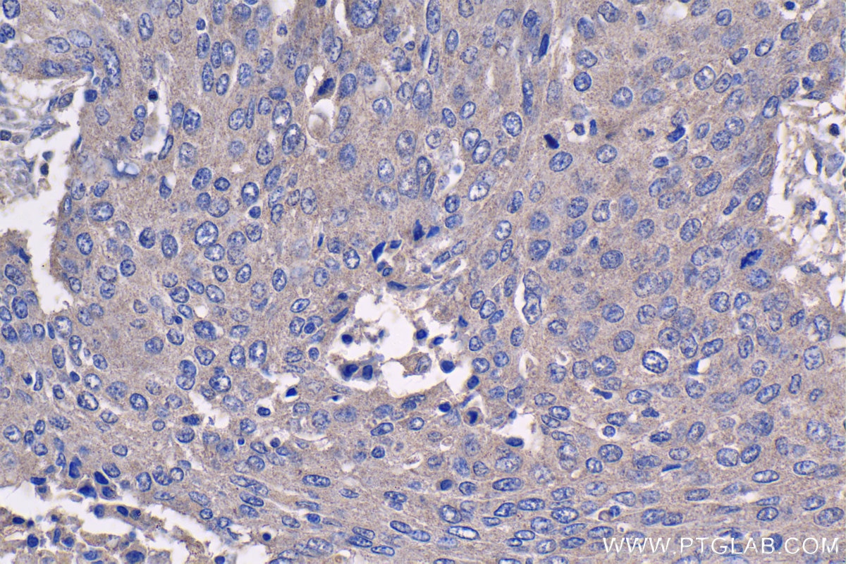 Immunohistochemical analysis of paraffin-embedded human lung cancer tissue slide using KHC1430 (AIM2 IHC Kit).