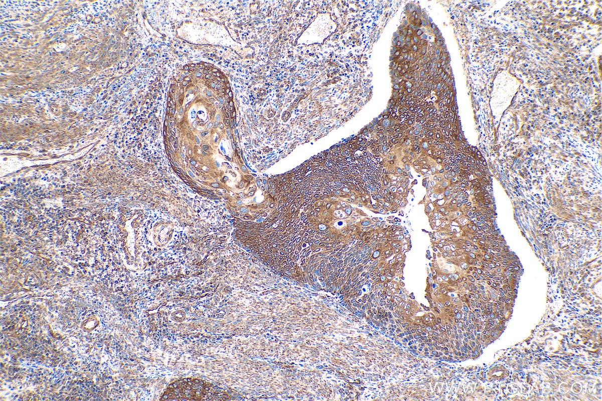 Immunohistochemical analysis of paraffin-embedded human cervical cancer tissue slide using KHC0845 (AIMP1 IHC Kit).