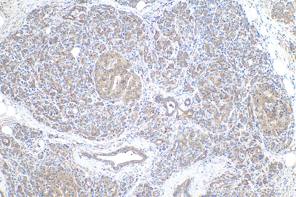 Immunohistochemical analysis of paraffin-embedded human pancreas cancer tissue slide using KHC0845 (AIMP1 IHC Kit).