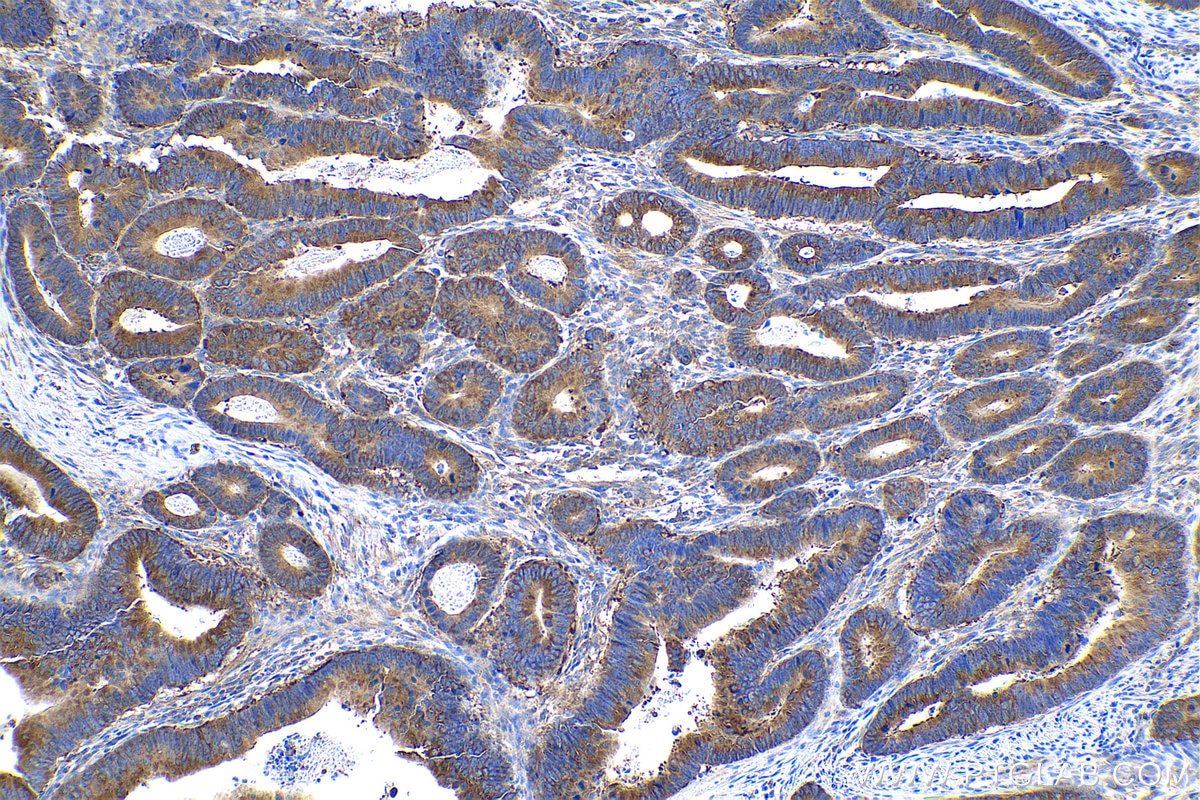 Immunohistochemical analysis of paraffin-embedded human colon cancer tissue slide using KHC0845 (AIMP1 IHC Kit).