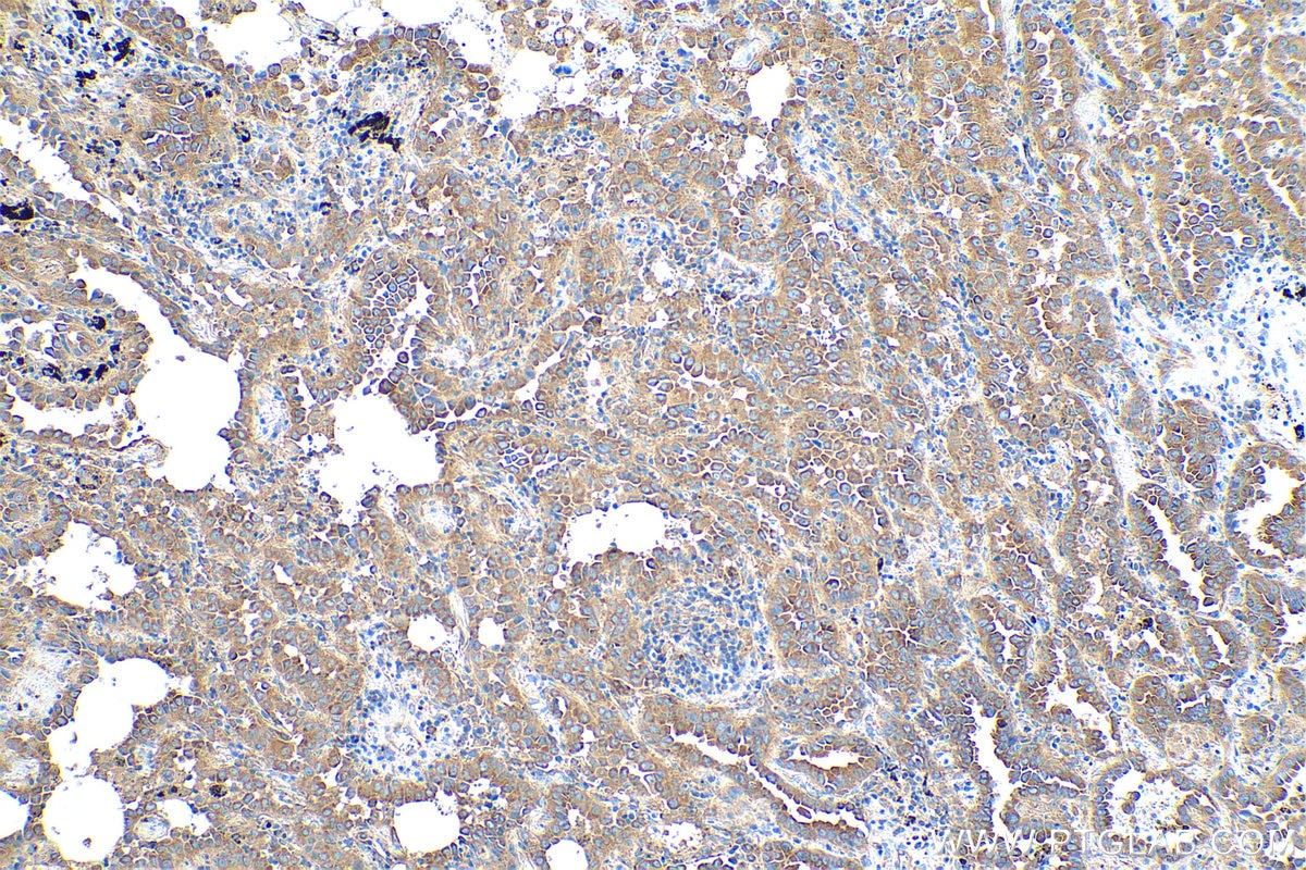 Immunohistochemical analysis of paraffin-embedded human lung cancer tissue slide using KHC0845 (AIMP1 IHC Kit).