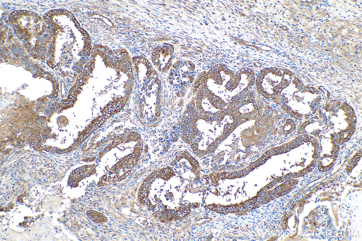 Immunohistochemical analysis of paraffin-embedded human ovary tumor tissue slide using KHC0845 (AIMP1 IHC Kit).