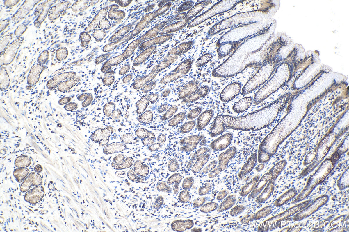 Immunohistochemical analysis of paraffin-embedded human stomach cancer tissue slide using KHC0993 (AIP IHC Kit).