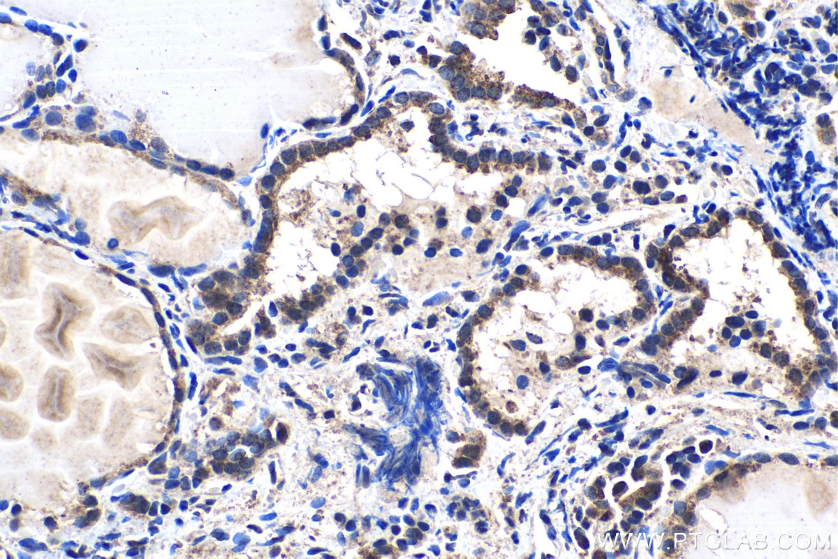 Immunohistochemical analysis of paraffin-embedded human thyroid cancer tissue slide using KHC1459 (AIRE IHC Kit).