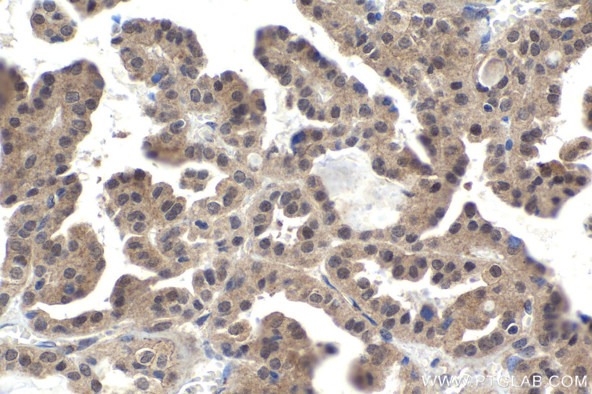 Immunohistochemical analysis of paraffin-embedded human thyroid cancer tissue slide using KHC1873 (AJUBA IHC Kit).