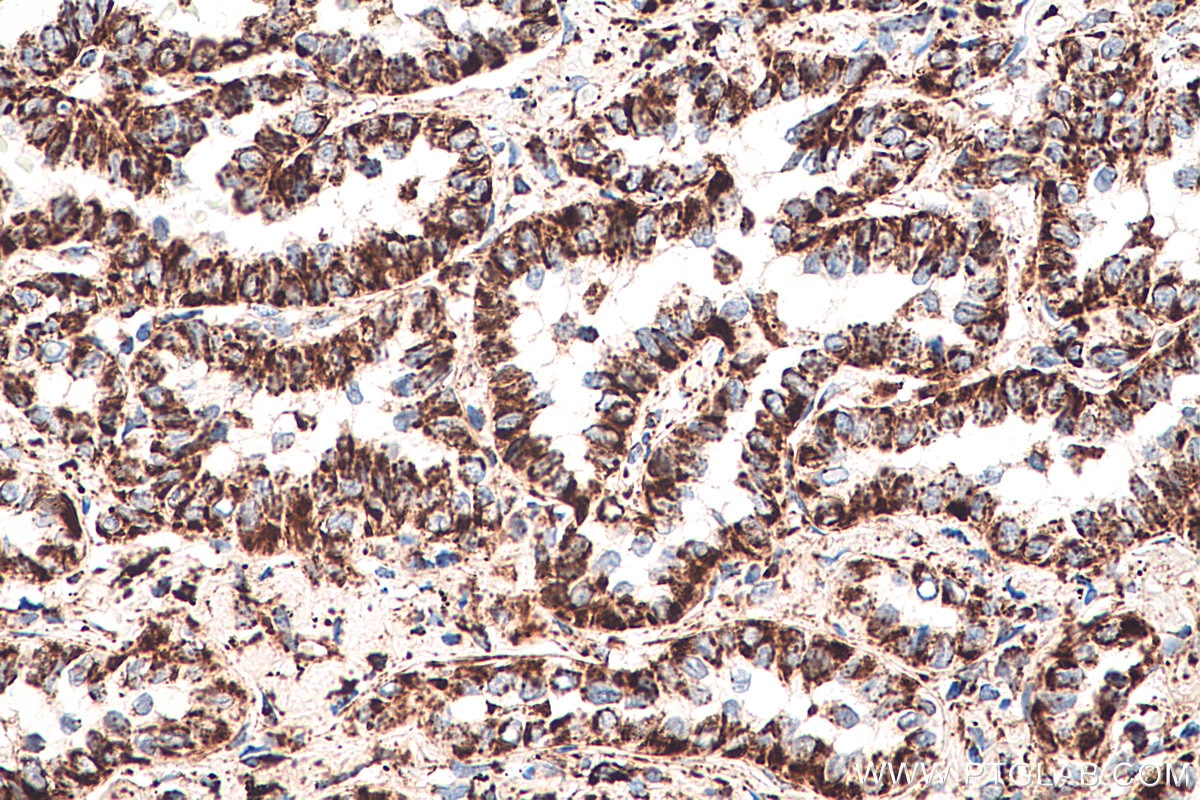 Immunohistochemical analysis of paraffin-embedded human lung cancer tissue slide using KHC0395 (AK2 IHC Kit).