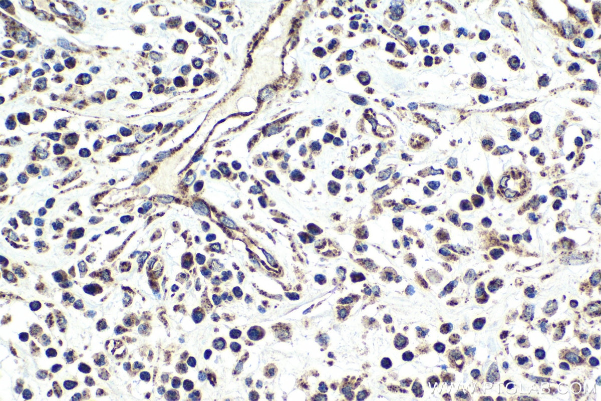 Immunohistochemical analysis of paraffin-embedded human colon cancer tissue slide using KHC0981 (AK4/AK3L1 IHC Kit).