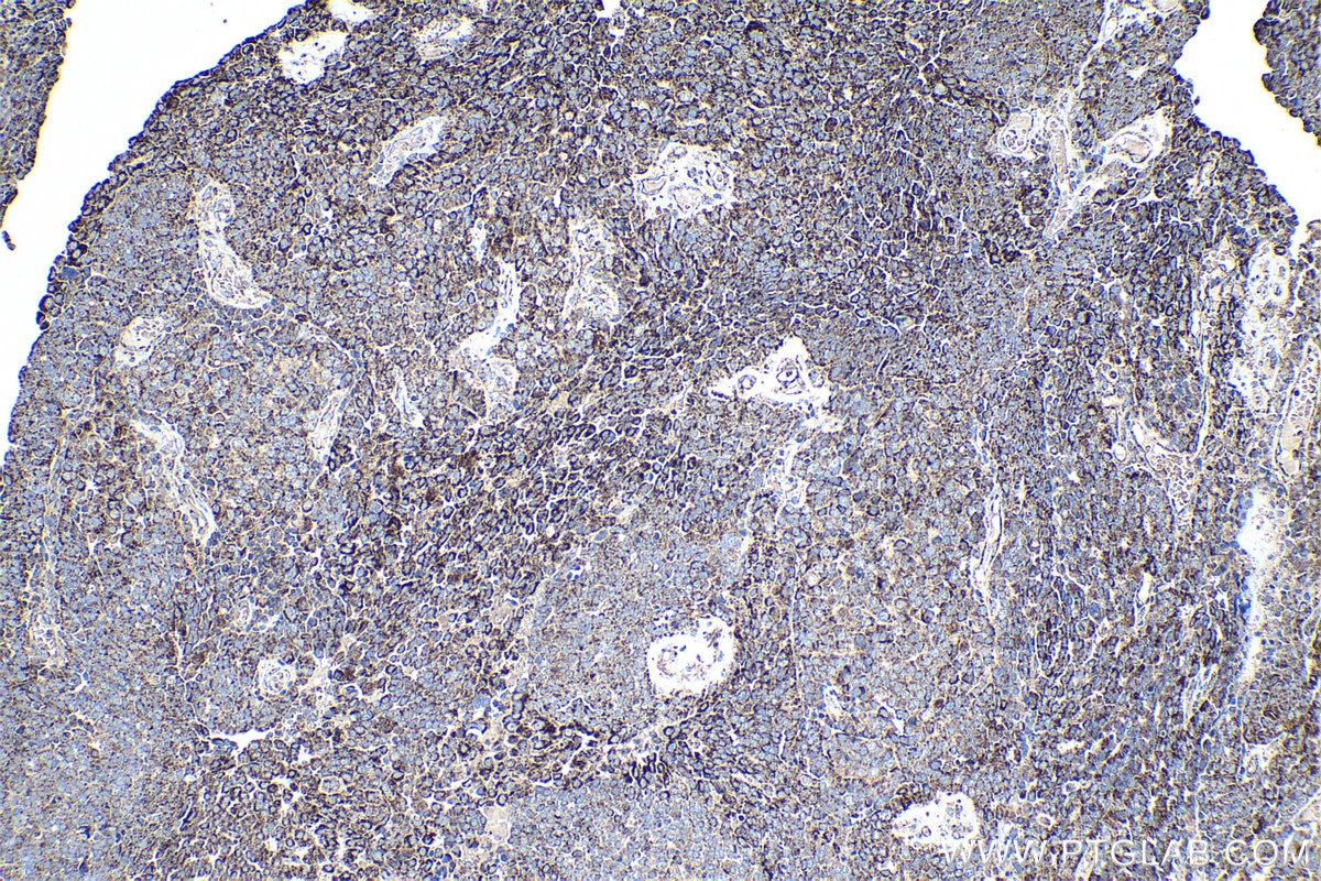 Immunohistochemical analysis of paraffin-embedded human ovary tumor tissue slide using KHC0981 (AK4/AK3L1 IHC Kit).